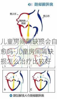 兒童房間隔缺損會自愈嗎-兒童房間隔缺損怎么治療比較好